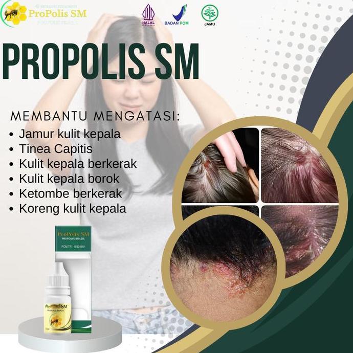 Propolis SM - Salep kepala berjamur, tinea capitis, ketombe berkerak, jamur kulit kepala, kepala bor