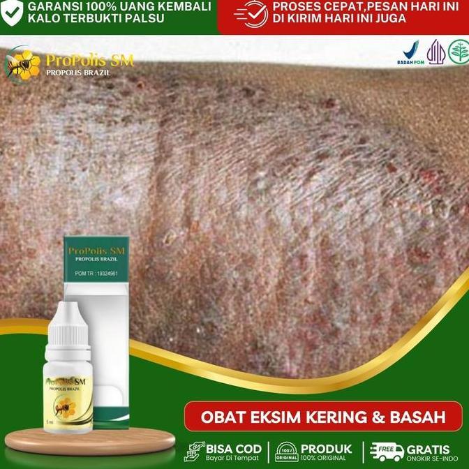 Feminin- Propolis Untuk Penyakit Kulit Eksim, Eksim Basah, Eksim Kering, Eksim Bernanah, Gatal Eksim