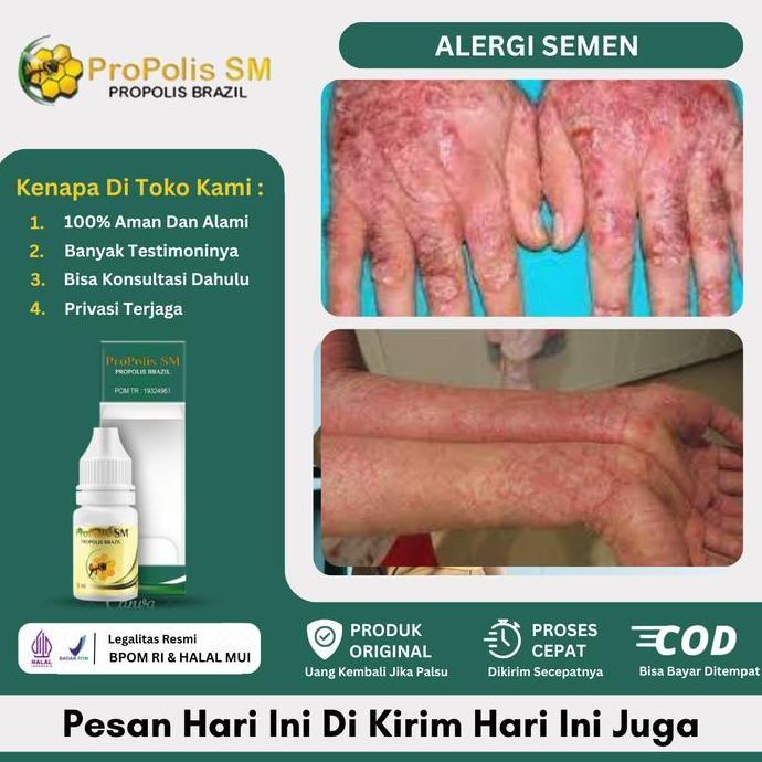 Feminin- Propolis Sm Alergi Semen, Dermatitis Kontak Di Kaki Dan Tangan, Penghilang Alergi Semen, Ru