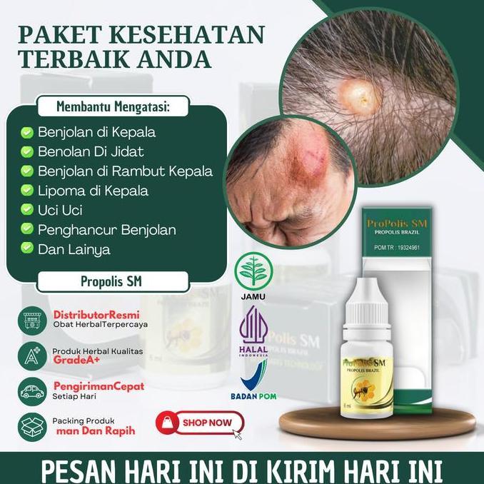 Propolis Sm Solusi Untuk Mengatasi Benjolan Di Kepala, Benolan Di Jidat, Benjolan Di Rambut Kepala, 