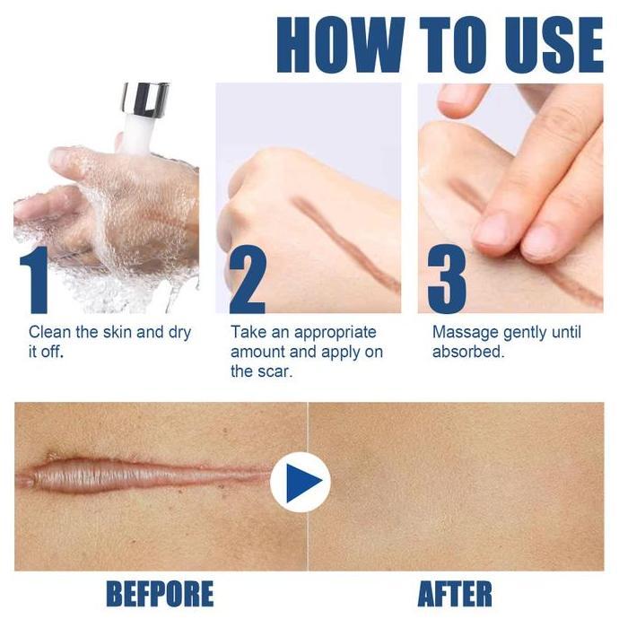 Uvanimal - Salep Penghilang Bekas Luka Lama Salep Keloid Paling 15G Salep Penghilang Bekas Luka Lama