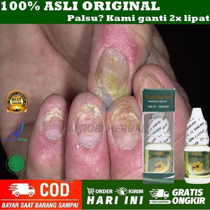 Obat Kuku Rusak dan Jamur - Obat Kuku Rusak - Prosiasis Kuku Jamur