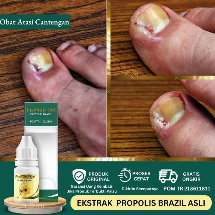 Cantengan, Kuku Cantengan Parah, Jempol Kuku Bengkak Bernanah, Atasi Cantengan Bau Busuk Perawatan K