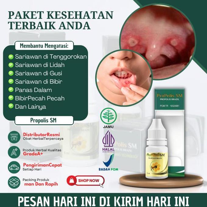 promo Propolis SM Solusi Untuk Mengatasi Sariawan Parah, Sariawan di Tenggorokan, Sariawan di Lidah,