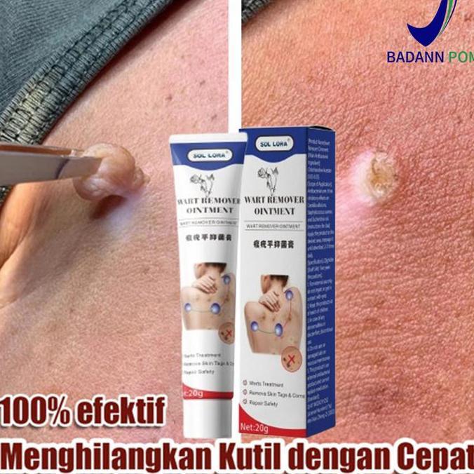 Bodies- Penghilang Tahi Lalat Dan Kutil 20G Penghilang Kutil Paling Ampuh Penghilang Kutil Obat Kuti