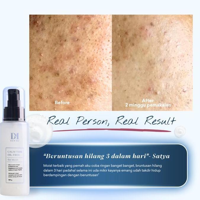 Langsung- Dew Me Calm Tide Moisturizer Gel Ringan Kulit Berminyak Jerawat Sensitif Pelembab Acne No 