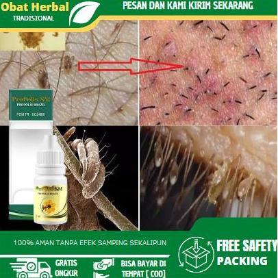 Cairan Tetes Penghilang Kutu Kemaluan, Gatal Kelamin, Kutu Di Rambut Kemaluan Pria Dan Wanita, Kulit