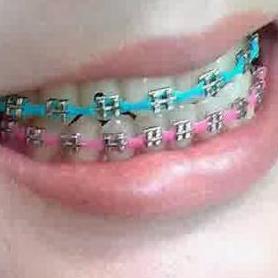 Behel Lepas Pasang Asli Atas & Bawah Power Chain Kualitas Terbaik Harga Termurah