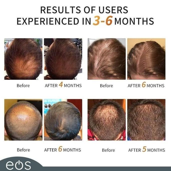 Terapi Perawatan Topi Rambut Kepala Infrared LED Merah