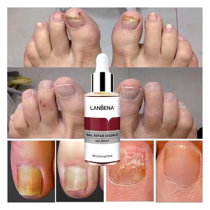 Lanbena Nail Repair Essence Oil Serum Nail Treatment