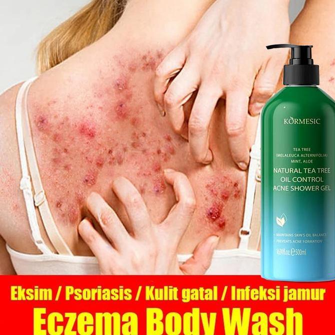 BERKUALITAS Eczema body wash gatal kulit gel shower Pengobatan Eksim Psoriasis Kurap Gatal kulit Jam