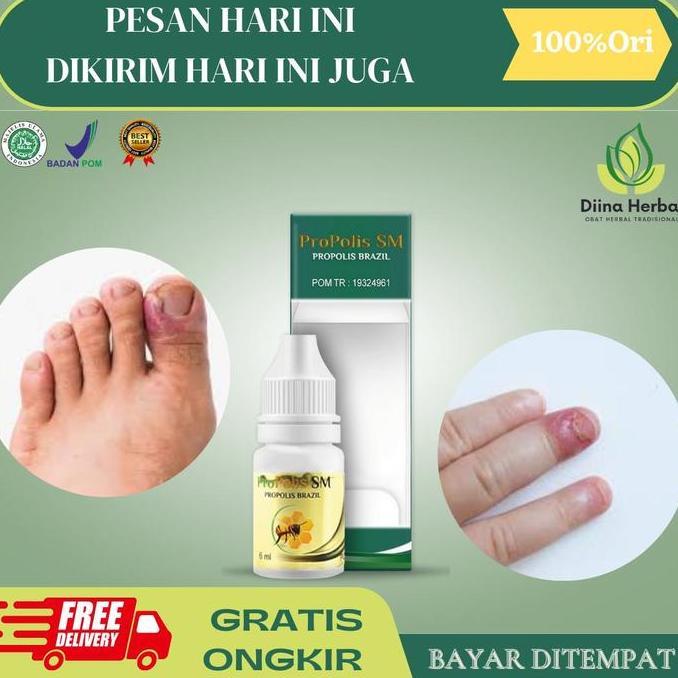 Cantengan Jempol Kaki, Kuku Cantengan, Cantengan Jari Tangan, Cantengan Jempol Kuku, Jempol Kaki Ben