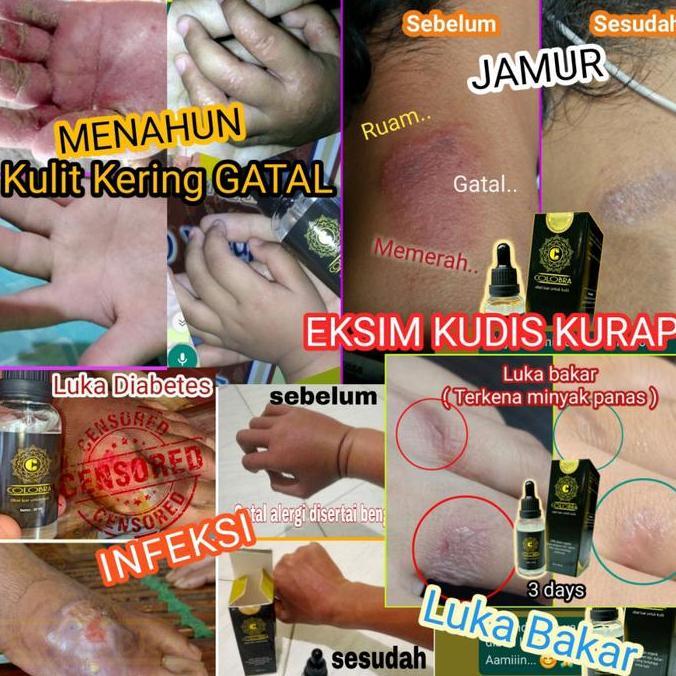 Cod,Bisa- Obat Kulit/Obat Gatal Selangkangan/Colobra/Obat Kulit Herbal