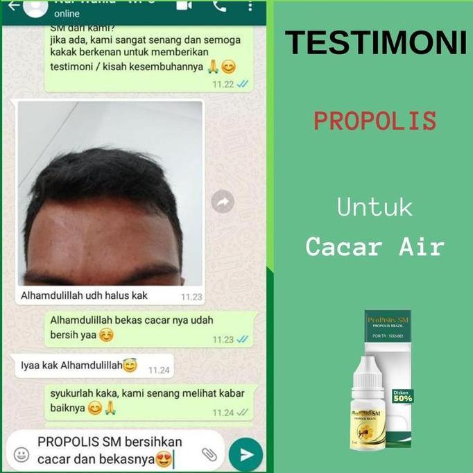 Murah Propolis Sm Atasi Bekas Cacar, Berlubang, Bekas Cacar Menghitam, Cacar Air Anak, Obat Cacar Di