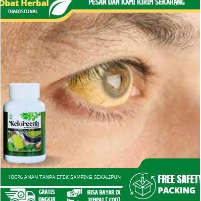 Solusi Untuk Mengatasi Mata Kuning, Pembersih Mata Kuning, Penjernih Mata, Pemutih Bola Mata Kuning,