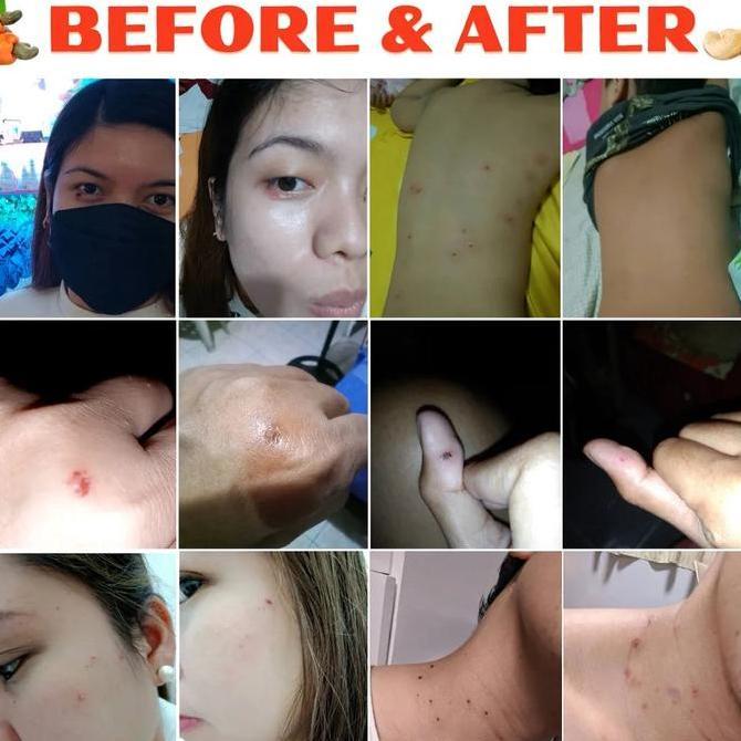 Penghilang kutil Obat kutil dan tahi lalat Penghilang tahi lalat di wajah Obat kutil kelamin