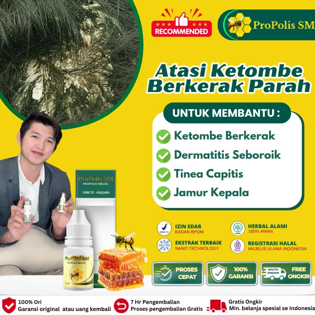 Obat Ketombe Berkerak Parah Berkerak Salep Borok Kulit Kepala Anti Ketombe Psoriasis Kulit Kepala Ke
