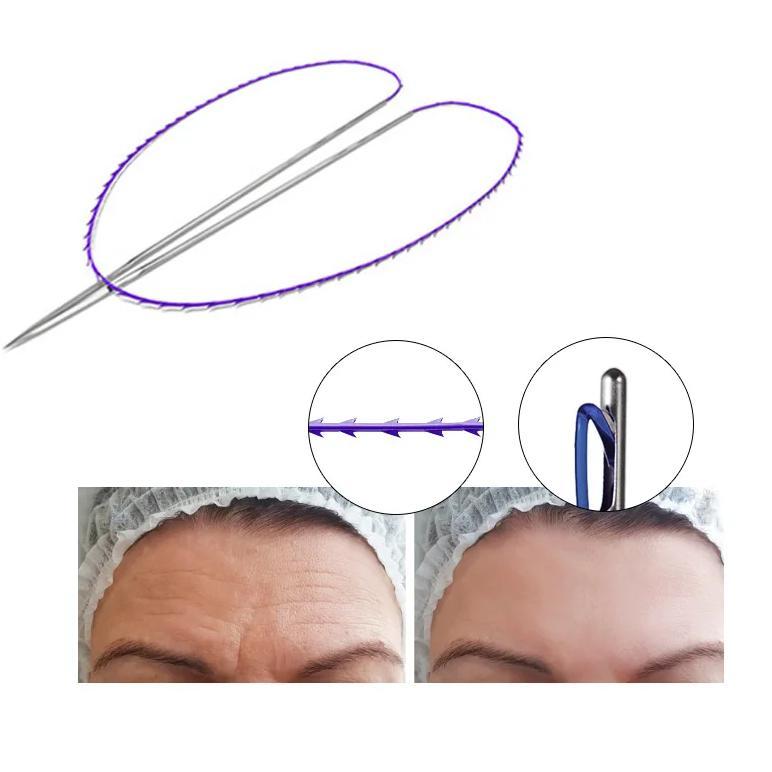 Medical Grade  Cog Pdo Thread Lift Double Needle Thread 5pcs/bag  For Face Neck Beauty Lifting