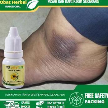 Salep Untuk Mengatasi Mata Kaki Hitam Dan Kasar, Mata Kaki Hitam Kapalan, Sakit Mata Kaki Karena Ges