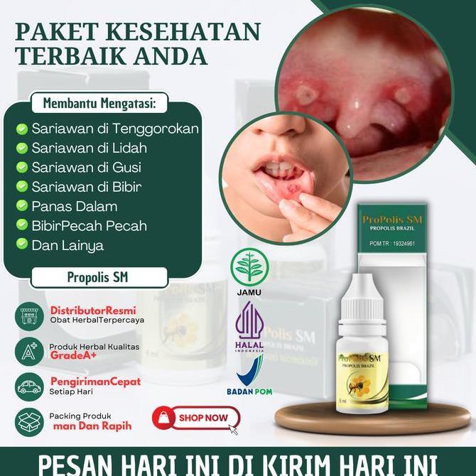 Propolis Sm Solusi Untuk Mengatasi Sariawan Parah, Sariawan Di Tenggorokan, Sariawan Di Lidah, Saria