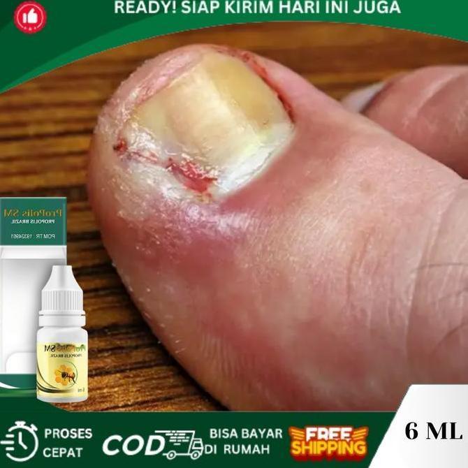 Tetes Cantengan Jempol Kaki, Kuku Jempol Nyeri Bau Busuk, Jempol Kaki Bengkak Bernanah, Kuku Jamur d