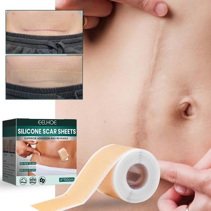 EELHOE Patch Perbaikan Bekas Luka Silikon Kehamilan Operasi Cesar Bekas Luka Noda Kulit Patch Kecant