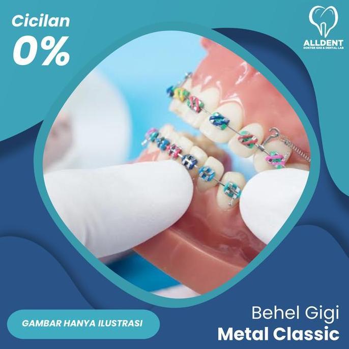 Behel Gigi Metal Classic Kualitas Terbaik Harga Termurah