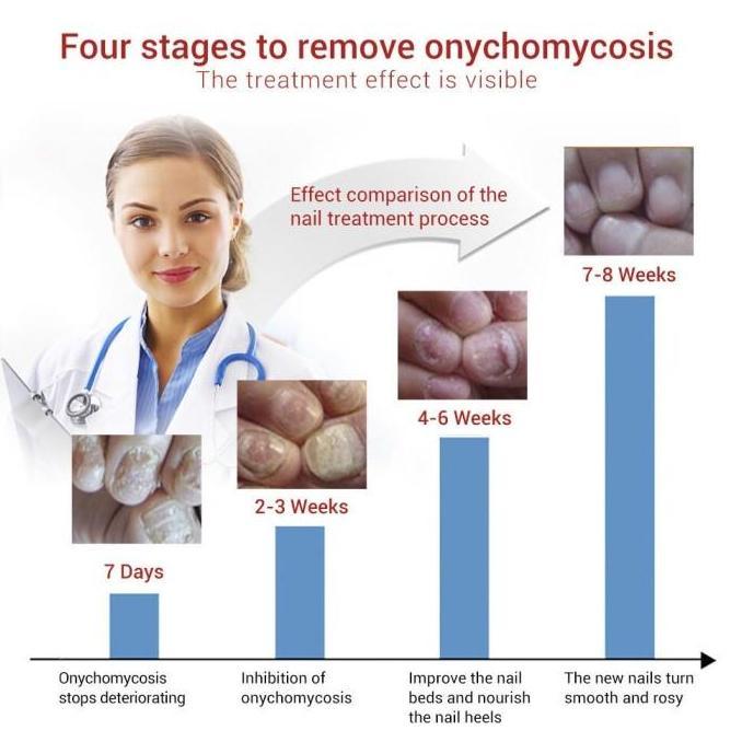 Serum Kuku LANBENA Nail Repair Essence Serum Kuku Obat Jamur Kuku Vitamin Kuku Ampuh