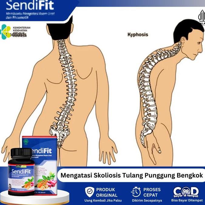SUPLEMEN UNTUK MENGATASI SKOLIOSIS TULANG BELAKANG BENGKOK, TULANG PINGGANG BERGESER, TULANG BELAKAN