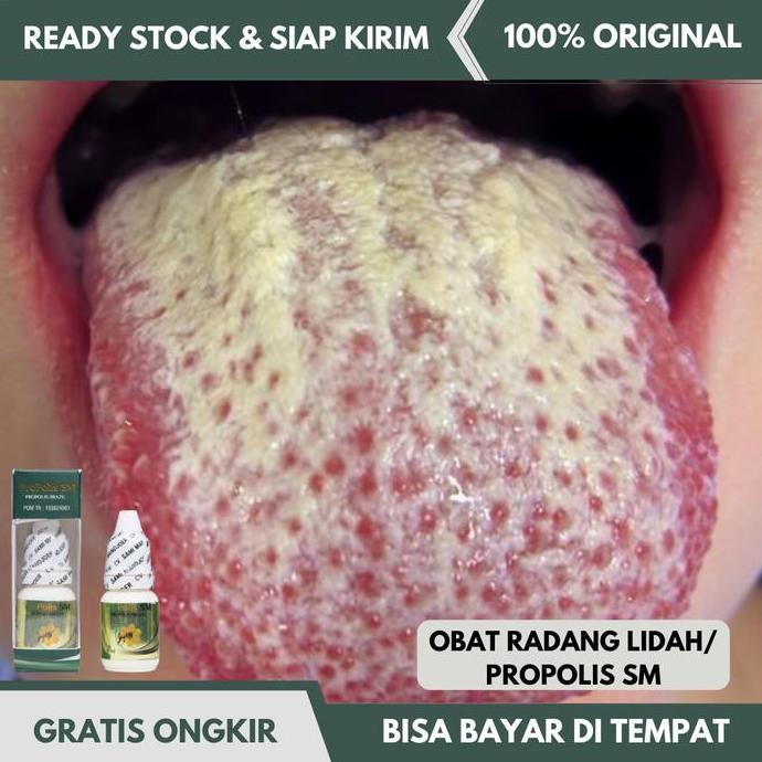 Obat Radang Lidah, Obat Lidah Putih,Bercak Putih di Lidah, Kandidiasis BISA GRAB