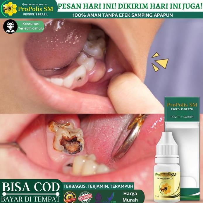 Obat Penghancur gigi Berlubang, Perontok Akar Gigi dan Karang Gigi