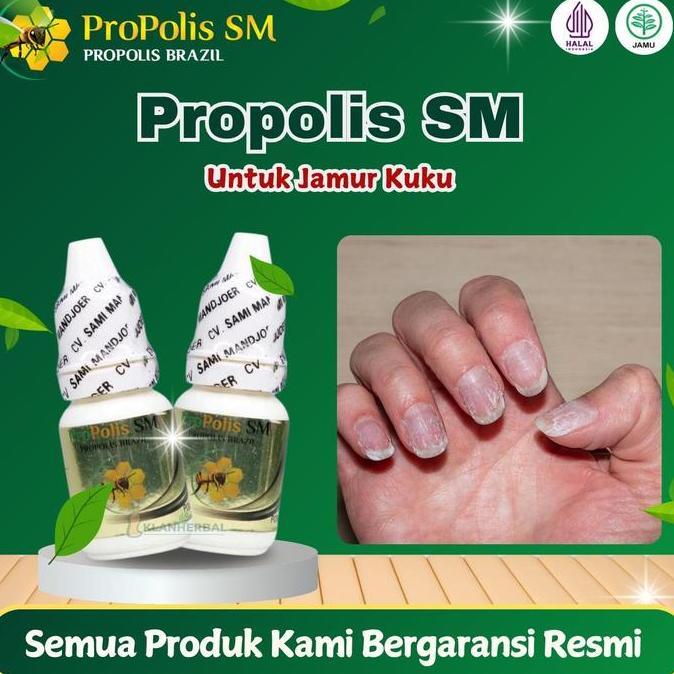 Jamur Kuku, Cantengan jempol Kuku, Kuku bernanah, Kuku berair, Psoriasis Kuku Propolis SM 6 ml