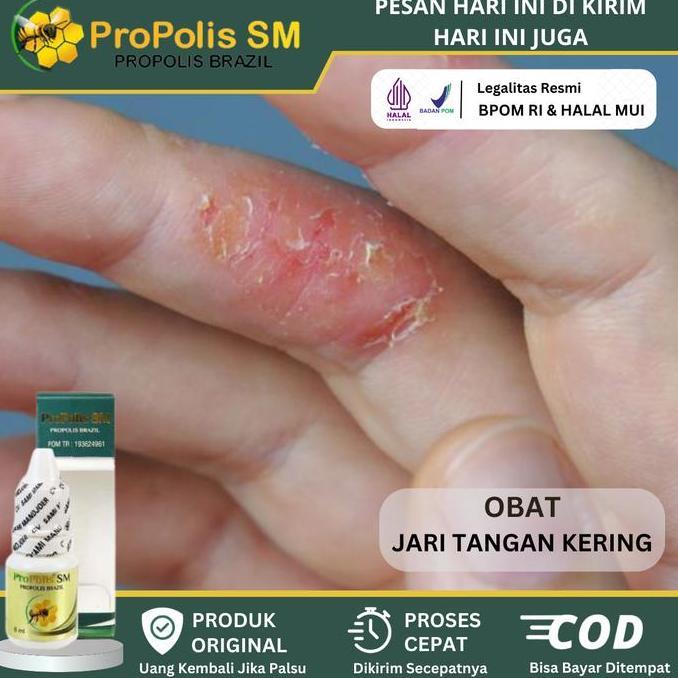Herbal Tetes Jari Tangan Kering, Kulit Alergi Detergen, Kulit Mengelupas, Jari Tangan Kasar, Kulit P