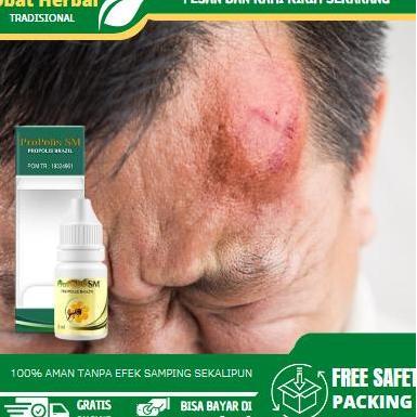 Solusi Untuk Mengatasi Benjolan Di Kepala, Lipoma Di Kepala, Benjolan Di Dahi Jidat Kening, Benjolan