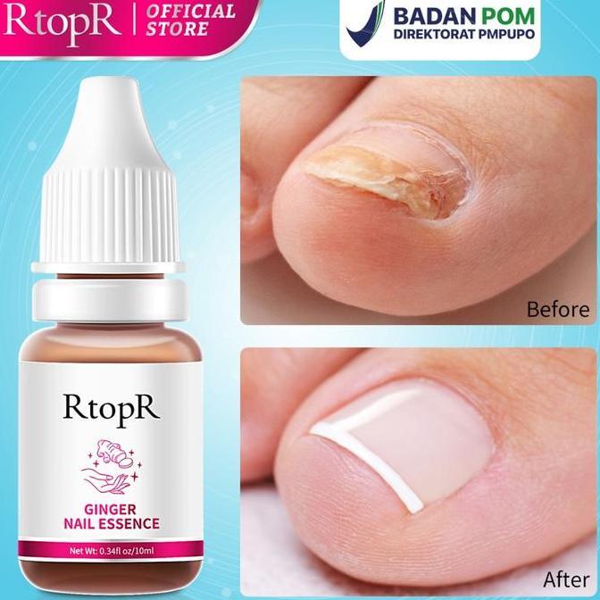 Sumimasen- Rtopr Ginger Nail Essence Treatment | Perawatan Jamur Kuku, Kuku Rusak/Tidak Sehat 10Ml