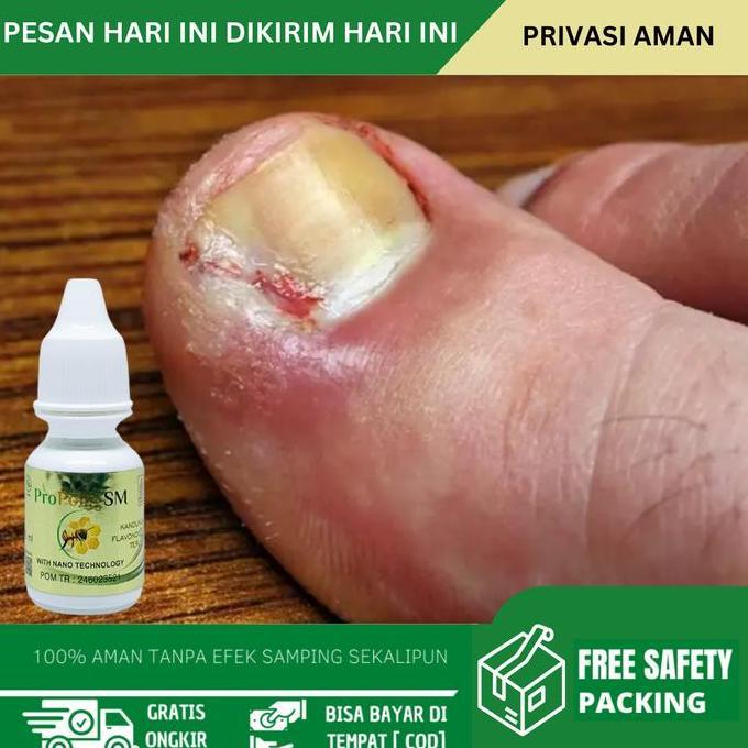 Tetes Atasi Cantengan, Cantengan Jempol Kaki,  Kuku Kaki Rusak, Kuku Tangan Rusak, Infeksi Jamur Kuk