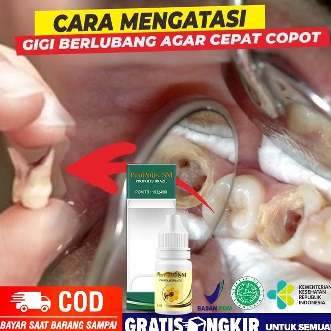 Obat Perontok Gigi Berubang, Perontok Gigi Bolong / Penghilang Sisa Gigi Berlubang, Pencabut GIgi Go