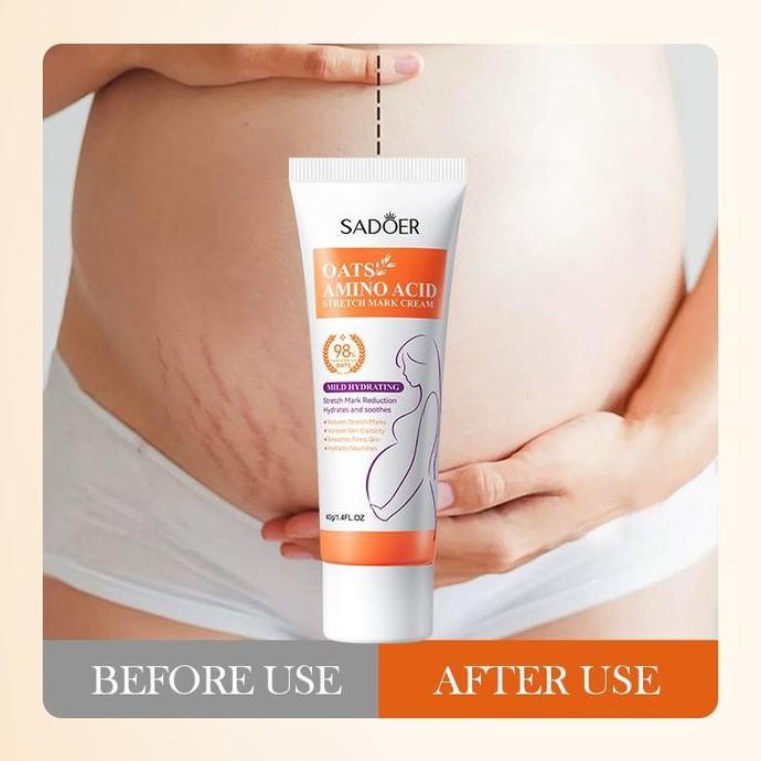 Krim Penghilang Stretch Mark Krim Stretch Mark Ori BPOM Stretch Mark Cream Penghilang Bekas Luka Kri