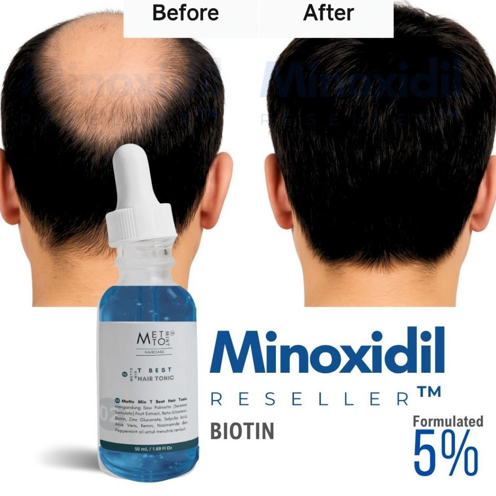 Minoxidil 5% Reseller Biotin Penumbuh Rambut Reseller Minoxidil 5% Minoxidil 10% Minoxidil 15%