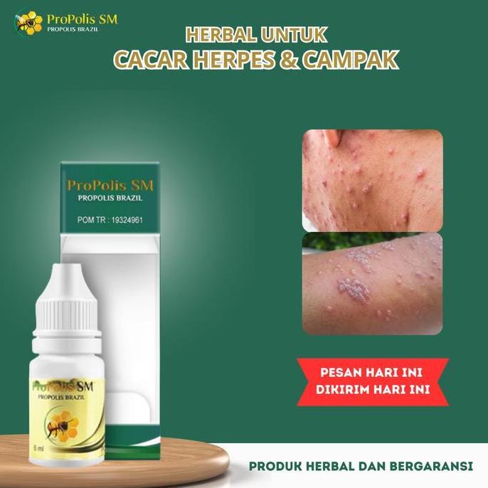 Sale Pembersih Cacar Air Anak Dewasa Penghilang Bekas Cacar Tampek Cacar Api Kulit Bintik Berair Her