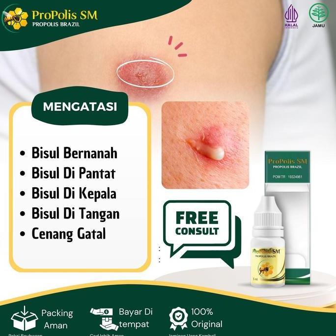 Sale Propolis Sm Untuk Menghilangkan Bisul Bernanah Bisul Di Pantat Bisul Di Kepala Bisul Di Tangan 