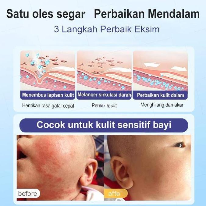 Uvanimal - BpomSalep Eksim Kering Paling Ampuh 3G- Cream Mengi Eksim Calming Cream Untuk Pereda Eksi