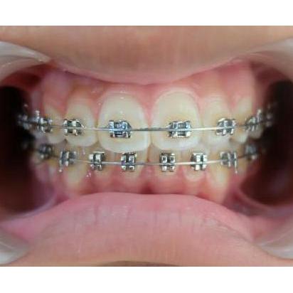 Behel Gigi Metal Kualitas Terbaik Harga Termurah