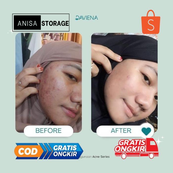 IK69 Daviena Skincare Paket Acne Series Deviena Davina Devina Skincare Official Skincare Original