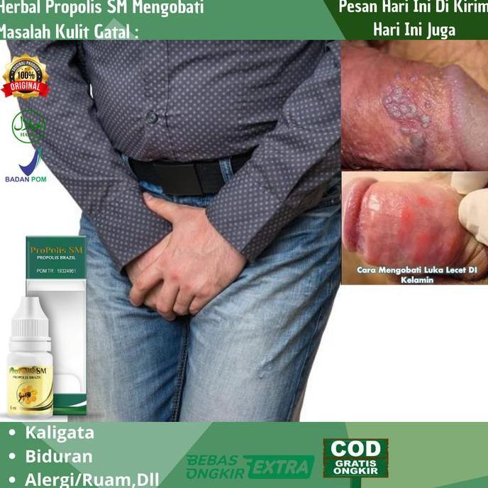 Osso- Obat Gatal Kemaluan Pria, Obat Gatal Kelamin Pria Lecet Herpes Kelamin
