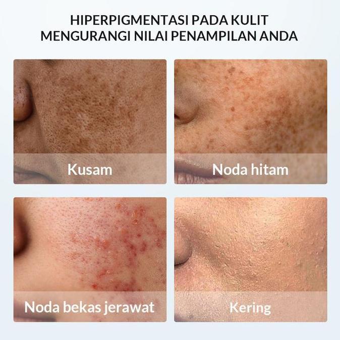 Bytoi- Bioaqua Symwhite 377 Whitening & Fade Dark Spot Paket Skincare Set