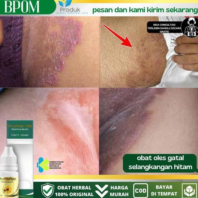 Propolis sm  Untuk Menghilangkan Gatal Di Area Selangkangan
