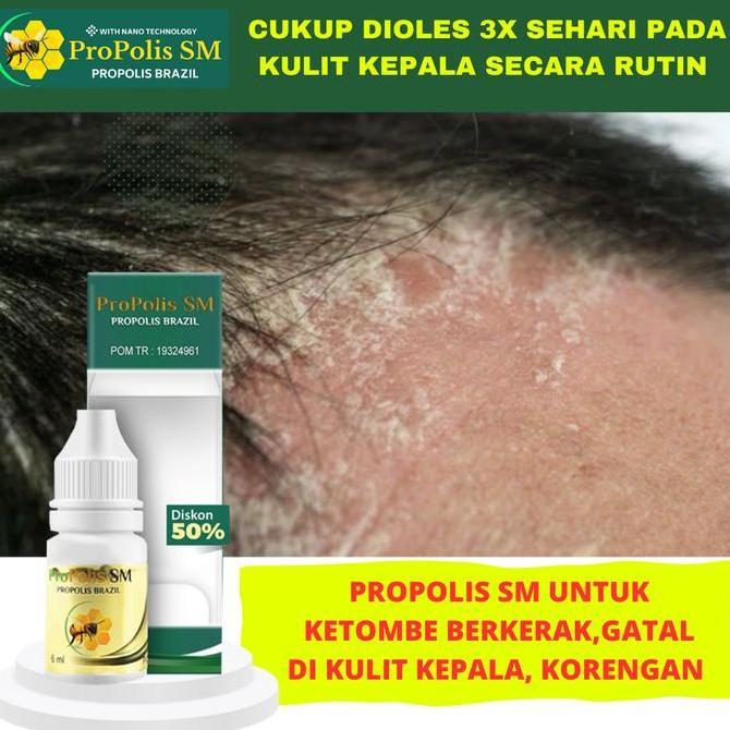 Propolis sm Salep Untuk Ketombe Berkerak, Kulit Kepala Bersisik