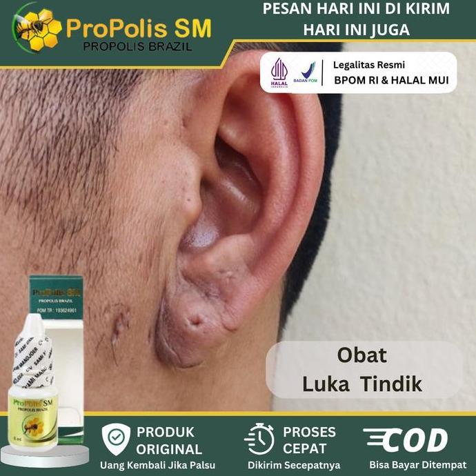 Mengobati Keloid Luka Tindik, Keloid Di Telinga, Keloid Menonjol Tahunan, Keloid Daging Tumbuh, Benj