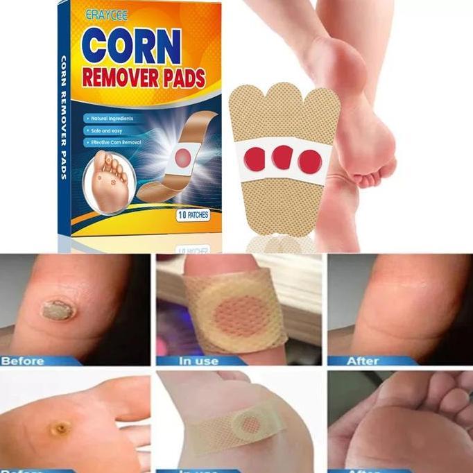 Bytwx- Plester Mata Ikan Plester Obat Kutil Foot Corn Removal Penutup Kutil Obat Mata Ikan Kapalan C